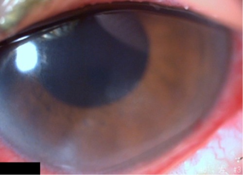 Figure 3 Slit lamp image from 3 weeks after the start of treatments with Mucosta ophthalmic suspension.