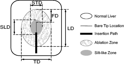 Figure 1. Ablation zone measurement. For each ablation zone, longitudinal diameter (LD) defined as distance along electrode insertion path, transverse diameter (TD) defined as maximum distance perpendicular to longitudinal axis, and front distance (FD) defined as distance from applicator tip to end of longitudinal diameter along insertion path. For silt-like zone within ablation zone, longitudinal diameter (SLD) defined as distance along electrode insertion path and transverse diameter (STD) defined as maximum distance perpendicular to longitudinal axis.