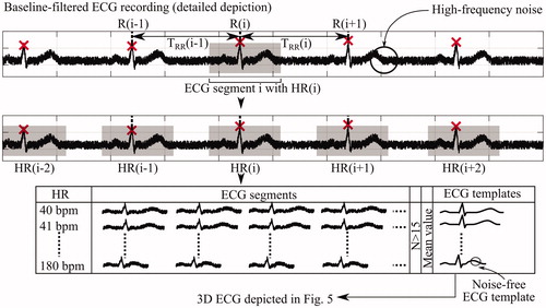 Figure 3. Visual representation of ECG template generation. At the beginning, each individual ECG segment is identified based on its R-peak. Next, the associated heart rate (HR) is determined by inclusion of neighbouring R-peaks according to EquationEquation (1)(1) HR(i)=60TRR(i−1)+TRR(i)2=120TRR(i−1)+TRR(i)[bpm](1) . Afterwards, all segments with equal heart rate are organised in the same group and aligned such that R-peaks are congruent. If at least 15 segments are contained in a respective group, ECG templates for that HR are obtained by averaging all segments, which attenuates high-frequency noise.