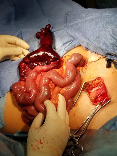 Figure 1 Intraoperative image of Meckel’s diverticulum and non-viable bowel released from the hernia sac and extricated through midline laparotomy prior to resection.