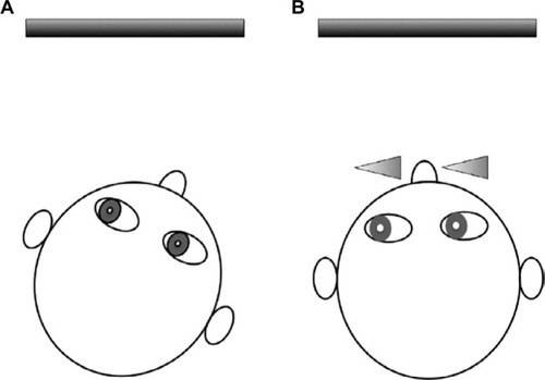 Figure 3 Example of reducing a right AHP (A) using base right prisms to shift the eyes into the direction of the null zone (left gaze) while the head is in primary position (B).
