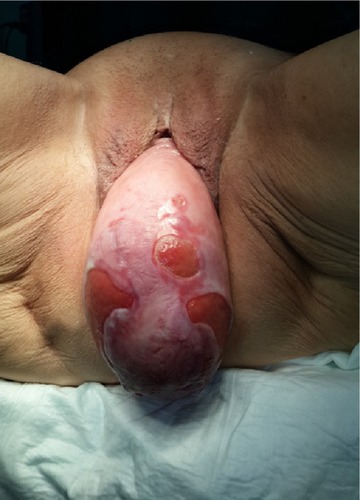 Figure 1 A patient with stage 4 pelvic organ prolapse.