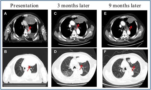 Figure 1 Chest CT scans demonstrating a left upper lung lobe lesion, (A and B) at diagnosis, (C and D) following 3 months of anlotinib treatment, and (E and F) following 9 months of anlotinib treatment.