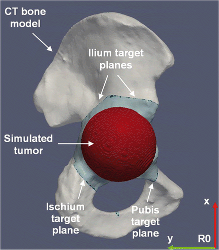 Figure 2. Preoperative planning of tumor cutting on the 3D CT model of the hemipelvic bone. The tumor is simulated by a sphere centered on the acetabulum. The planning consists of four target planes defining the desired cutting of the simulated tumor, including a first plane in the ischium, a second plane in the pubis, and a third and fourth plane forming two angular cuts in the ilium. The plane coordinates are expressed in the reference frame R0.