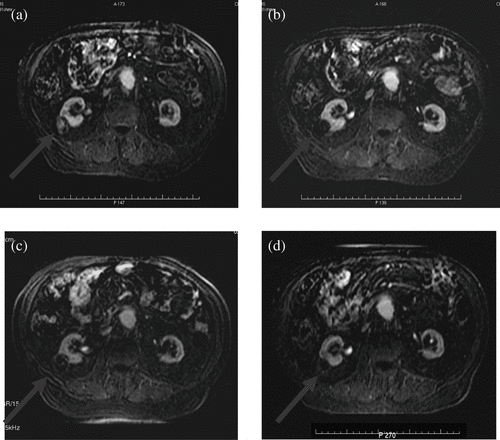 Figure 2. A patient with a renal tumour treated as part of the Oxford trial. Axial T1W MRI (1 min post-gadolinium contrast) subtraction films. (a) Renal tumour showing contrast enhancement before HIFU. Ablated region with absent contrast uptake (b) 12 days, (c) 6 months and (d) 1 year after HIFU.