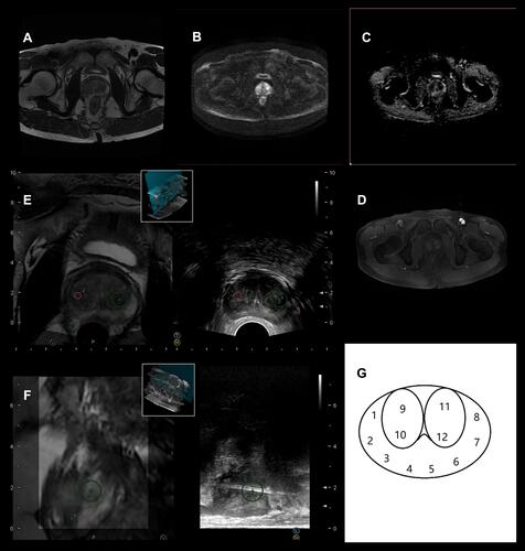 Figure 1 Patients with region of interest (ROI) in left-middle posterior transitional zone. (A) T2WI sequence; (B) DWI sequence; (C) ADC sequence; (D) DCE sequence; (E) MRI and ultrasonography fusion imaging by RVS; (F) perform targeted biopsy; (G) 12-cores systematic biopsy template.