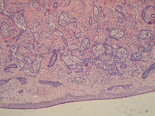 Figure 2 The tumor composed of irregularly shaped lobules enmeshed in a dense fibrous stroma.