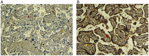 Figure 2. (A) PLGF expression at 200× magnification in Placenta Previa show weak intensity with percentage of cells 0-10%. Blue arrow indicates IHC stained in the villous trophoblast. Red arrow indicates the mesenchymal cell. Yellow arrow indicates the blood vessel in the placental villous. (B) Strong intensity of PLGF expression at 200x magnification in FIGO grade 3. Percentage of cells ≥ 50% with strong intensity of villous trophoblast (blue arrow). Red arrow indicates the mesenchymal cell. Yellow arrow indicates the blood vessel in the placental villous.