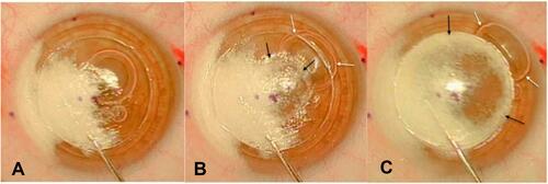 Figure 1 Type 1 big bubble formation with stromal whitening. (A) Stromal whitening extending from the site of air injection to the limbus on one side. (B) Central commencement of Type 1 bubble (black arrows) with displacement of the anterior chamber (AC) bubbles to the periphery (white arrows). (C) Complete formation of Type 1 bubble.