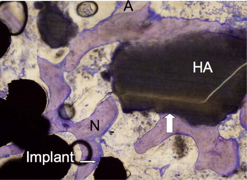 Figure 6. The implant-bone interface showing gap healing and ongrowth of bone onto the implant and HA. New bone (N), preserved allograft (A), ongrowth onto the implant (thin arrow), and ongrowth onto the HA (thick arrow). 10× objective.