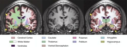 Figure 2 Coronal MRI image from a male subject with alcoholism showing the results of segmentation from FreeSurfer (left) and CMA (right) in relation to a reference T1 image (center). Arrows (yellow) indicate regions of disagreement between FreeSurfer and CMA regarding the exterior boundary of the brain (lower arrows) and the extent of the white matter into the cortical gyri (upper arrow). There are also diffuse differences in the estimation of sulcal depth.