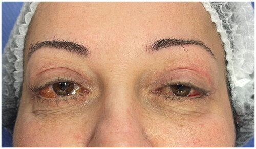 Figure 4. Chemosis was still present two months after upper and lower lid blepharoplasty.