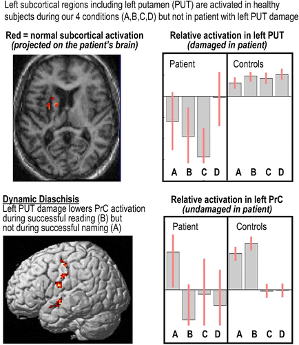 Figure 3. An example of dynamic diaschisis (unpublished data). Following a lesion to the left putamen (see Figure 1), activation in the left precentral cortex (PrC in Figure 1) is abnormally low during successful reading but normally activated during successful object naming. This is consistent with the dynamic causal modelling (DCM) results reported in Figure 1 and suggests that PrC activation is driven by left putamen activation during reading but not naming. See Figure 2a for details of Conditions A, B, C, and D. To view a colour version of this figure, please see the online issue of the Journal.