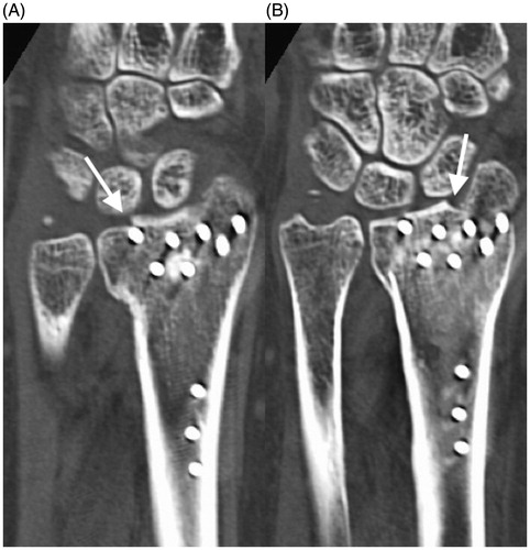 Figure 1. CT images showing an irregular articular surface due to poor reduction in the initial surgery.