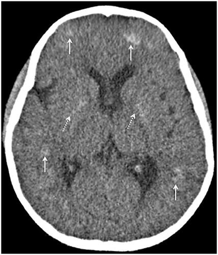 Figure 1. Axial brain computed tomography. Multiple hyperattenuating foci in the subcortical regions (white arrows) and putamen (dotted white arrows).
