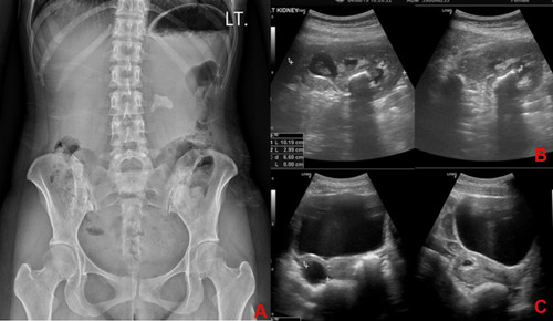 Figure 1 (A) KUB films at a gestational age of 4 weeks showing a left kidney stone that was approximately 3 cm in diameter. (B) Ultrasonography of the left kidney showing left hydronephrosis and a left kidney stone. (C) Ultrasonography of the bladder showing a normal bladder mucosa and a gestational sac in the uterus.