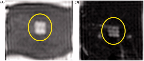 Figure 7. Examples of T2-weighted MR images of ex vivo porcine heart and liver obtained post-sonication using parameter sets A (panel A) and D (panel B). The images reveal a square-shaped hyperintense region (yellow circle) consistent with the square sonication grid pattern and with the square fractionated and partially liquefied lesion. Image in panel B also reveals nine spatially distinct points consistent with the sonication grid. (Colored version is available on the journal’s webpage).