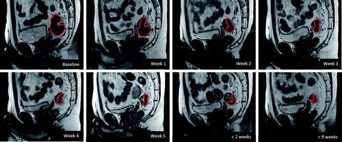 Figure 1. Example of tumor regression over time in a single patient (sagittal T2-weighted images). Decrease in GTV volume (red) is already visible in the first week of CRT.