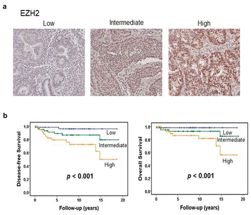 Figure 1. EZH2 expression in human endometrial cancers. (a) Representative image of human endometrial cancer with low, intermediate, or high EZH2 expression based on immunohistochemical staining. (b) Kaplan-Meier survival curve for endometrial carcinomas patients with low, intermediate, or high level of EZH2. Log-rank test was used to compare differences among the three groups. Increased EZH2 expression was significantly associated with decreased overall survival and disease-free survival (p < .001 for both).