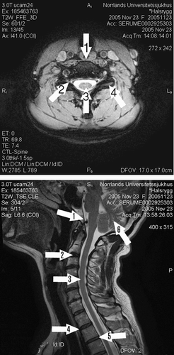 Figure 3. Anatomical localization of important structures in the cervical spine. Upper panel: 1 = ligamentum longitudinale anterior, 2 = foramen/nerve root channel, 3 = medulla spinalis, 4 = facet joint. Lower panel: 1 = superior longitudinal band of cruciform ligament; immediately below this is the alar ligament, 2 =cervical disc, 3 = medulla spinalis, 4 = ligamentum longitudinale anterior, 5 = ligamentum longitudinale posterior, 6 = cerebellum.