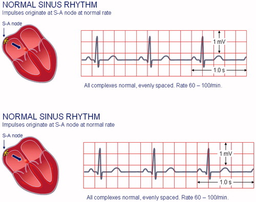 Figure 1. ECG for normal heart condition and AFIB [Citation11].