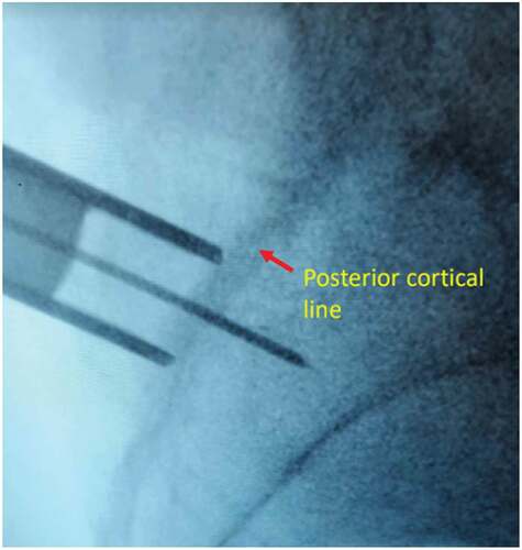 Figure 3. X-ray image of external dilator at the posterior cortical line in the lateral view.