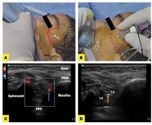 Figure 1. (A) Anatomical landmark of suprazygomatic maxillary nerve block. (B) The entry point of the needle is located at the frontozygomatic angle bounded by superior edge of the zygomatic arch below and posterior orbital edge forward. (C) Ultrasound images describe suprazygomatic maxillary nerve block; anatomy of PPF (pterygopalatine fossa) and TMM (tempromaxillary muscle) with guidance of Doppler flow (red color) to localize neurovascular bundle. (D) Local anesthetic (LA) spread in PPF