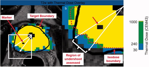 Figure 2. Measurement of thermal undershoot attributable to marker. On each post-treatment thermal dose map, the angular region affected by each fiducial marker was calculated (a). For this specific angular region (b), the target boundary (black) was compared to the isodose boundary (red). If the black target boundary is larger than the red isodose boundary, this is considered thermal undershoot.