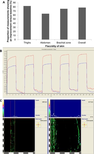 Figure 2 (A) Proportion of cutometer-evaluated skin flaccidity measurements that showed an improvement 5 weeks after treatment relative to baseline. (B) Representative cutometer trace from one subject who had their brachial zone treated, where red indicates before treatment and blue indicates after treatment. (C) Ultrascan trace recording density of the brachial zone skin from the same subject (left, before treatment; right, after treatment).