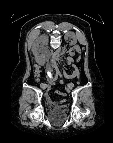 Figure 2 Coronal plane view of the right ureter showing possibility of stenosis in the distal part of the stone and hydroureter in the proximal part of the stone.