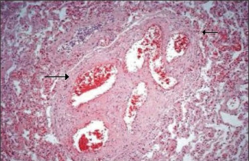 Figure 3 Pulmonary arteriopathy with thrombotic lesions arterioles with recanalized thrombi (arrows).