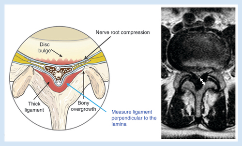 Figure 1. Axial cross-section of spinal cord depicting ligamentum flavum hypertrophy. (A) LF thickness (AP) measured perpendicular to the border of the lamina corresponding to the intervertebral disc. (B) MRI cross-sectional image demonstrating LSCS. Arrow demonstrates LFH measurement.