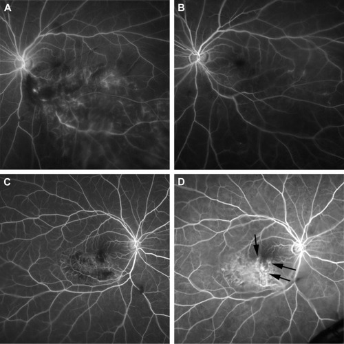 Figure 3 Microaneurysms detected by FA at month 6. (A and B) An early-phase FA image from a 62-year-old woman with BRVO. The patient received an initial IVR injection 1 month after disease onset. (A) A baseline FA image. (B) An FA image at month 6. No microaneurysms are seen. (C and D) Early-phase FA images from a 71-year-old woman with BRVO. The patient received an initial IVR injection 4 months after disease onset. (C) A baseline FA image. (D) An FA image obtained at month 6. Leaky microaneurysms (black arrows) are observed.