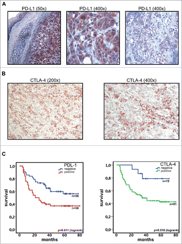 Figure 1. PD-L1 and CTLA-4 expression (analyzed by immunohistochemistry) is associated with inferior survival in gastric adenocarcinoma. (A) Gastric adenocarcinoma cells show a strong expression of PD-L1 (DAB, brown regions). Surrounding normal tissue and intramucosal glands are PD-L1 negative. Exemplary regions with membranous and cytoplasmatic staining are shown in larger magnification. (B) Representative images showing immunohistochemistry staining of CTLA-4 (DAB, brown regions). (C) Expression of PD-L1 or CTLA-4 in primary tumor cells was associated with inferior overall survival.