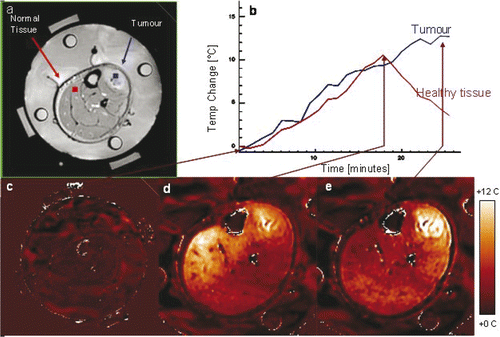 Figure 10. Dosimetry of a clinical hyperthermia treatment of an advanced fibrous histiocytoma (soft-tissue sarcoma) tumour in the lower leg. (A) Anatomic MRI of patient's lower leg inside MAPA applicator with 4 dipole antenna pairs and 4 silicon oil reference tubes. (B) Temperature as a function of time. (C) Baseline temperature change map after 4 min of imaging without heat – temperatures in the leg are stable; (D) Temperature change map at approximately 18 min into treatment – although tumour is heating, excessive heat is seen in normal tissue on the opposite side of leg; (E) 25 min into treatment after adjusting antenna phases to focus heat primarily in the tumour region at the upper right.