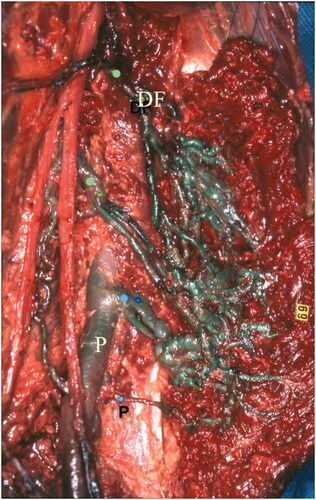Figure 2. Venous arcades of the semi-membranosus muscle, bypassing the Hunter canal by their lower arcades (blue dots) connected into the popliteal vein (P) and their higher arcades (green dots) connected into the deep femoral vein.