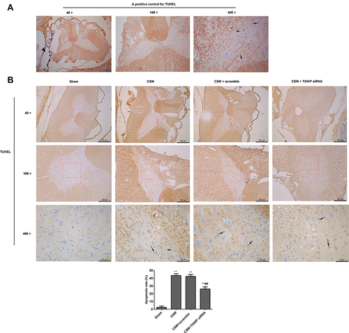 Figure 5 Inhibition of TXNIP reduced apoptosis in the anterior horn of the lesioned area following CSM. (A) Positive TUNEL staining control. (B) Apoptosis in the anterior horn of the lesioned area was analyzed by TUNEL staining. Black arrows show apoptotic cells. Apoptosis rate (%) = the numbers of apoptosis cells/total numbers of cells ×100%. The numbers of cells were counted using Image J software. Compared with the sham group, **P<0.01; compared with the scrambled group, ##P<0.01.