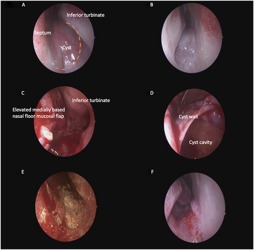 Figure 2. Endoscopic views during surgery. (A) Endoscopic view of the left nasal cavity showing the NPDC. (B) Endoscopic view of the right nasal cavity showing the NPDC. (C) A mucosal flap was elevated at the anterolateral aspect of the cyst and extended posteriorly along the nasal floor with a size 15 blade. This was performed unilaterally in the left nasal cavity. (D) A clear plane was developed between the mucosal flap and the cyst wall, which was removed. (E). A BIPP ribbon was applied to maintain the rotation of the flap into the cavity. (F) Right nasal cavity view after cyst decompression from the contralateral side. NPDC: Nasopalatine Duct Cyst; BIPP: Bismuth Iodoform Paraffin Paste.