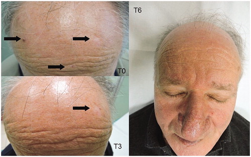 Figure 1. Visible improvement of AKs in immunocompetent patient during the study.