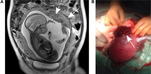 Figure 2 MRI of placenta percreta (fourth pregnancy).