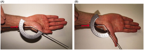 Figure 3. Radius-metacarpal angle was measured with the subject’s hand in a supinated position using a Moeltgen goniometer, which is placed along the longitudinal axis and the first metacarpal for assessing radial adduction (A) and radial abduction (B) (red arrow).