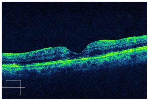 Figure 4 Postoperative OCT of traumatic macular hole with C3F8 gas.