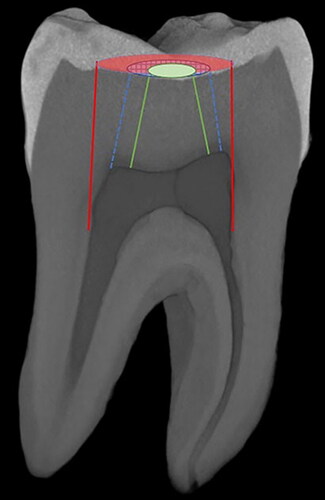 Figure 3. Micro-ct image of lower molar tooth from lateral view. Red area and lines indicate border of traditional endodontic access cavity. Blue area and lines indicate border of conservative endodontic access cavity. Green area and lines indicate border of ultraconservative endodontic access cavity.