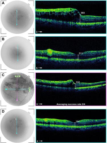 Figure 5 Male patient aged 48 years old presented with right upper temporal BRVO, the CMT was 393 um, the BCVA was 1.3 by log MAR (A), the patient received 3 consecutive intravitreal injections of ranibizumab (0.5 mg), the CMT declined to 211 um and BCVA improved to 0.4 after 3 months (B), after 6 months of the first injection, recurrent ME occurred with CMT 332 um and the BCVA declined to 1.2 by log MAR (C), the patient received two additional injections of ranibizumab, after 12 months of the first injection, the CMT was 194 um and BCVA improved to 0.3 (D).