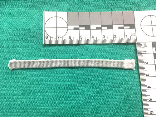 Figure 1. Photograph of the annuloplasty ring used in the modified aortic annuloplasty procedure.