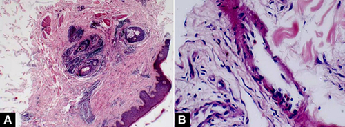 Figure 5 Right calf skin biopsy. (A) Epidermis is slightly thickened, and blood vessels in the middle and upper dermis are hyperplastic (hematoxylin staining [HE] × 40). (B) There is no obvious fibrinoid necrosis in the vessel wall, and no thrombosis is formed in the vascular cavity. The blood vessels are dominated by focal infiltration of the mononuclear cells, and scattered eosinophils can also be seen (HE × 200).