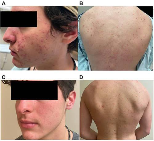Figure 1 (A and B) Images of patient before acne treatment (C and D) Improved acne after 3 months of oral doxycycline, benzoyl peroxide wash, and topical tretinoin followed by 2 months of isotretinoin.