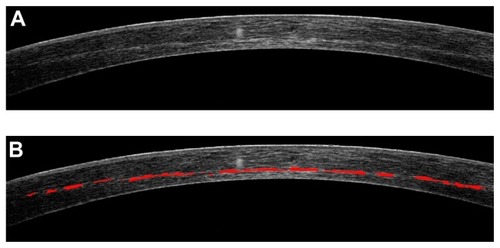 Figure 1 (A) Typical cornea cross-sectional meridian image of a patient with KCN. (B) The selected hyper-reflective intrastromal area is indicated in red.