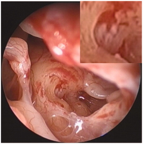 Figure 4. Intraoperative endoscopic findings of the right cochlear implantation. The superior bony overhang of the round window niche is removed. The round window membrane is white-colored and thickened. A magnified image of the round window membrane is inserted.