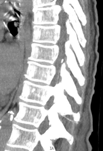 Figure 4 Thoracic spine CT showing the retained catheter fragment.